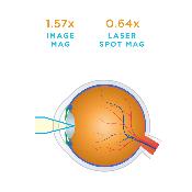 Verre Capsulotomie (Laser Yag) - VOLK
